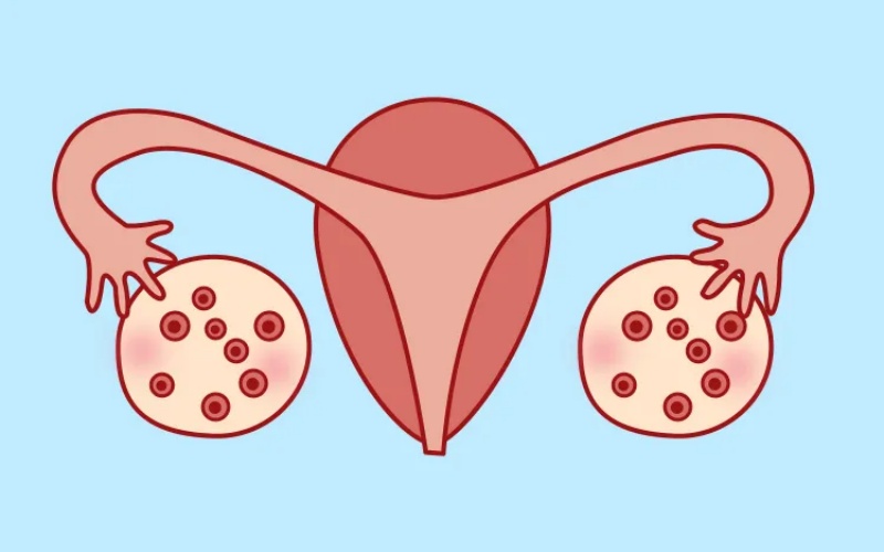 多囊卵巢综合征，是不是容易一次生俩？