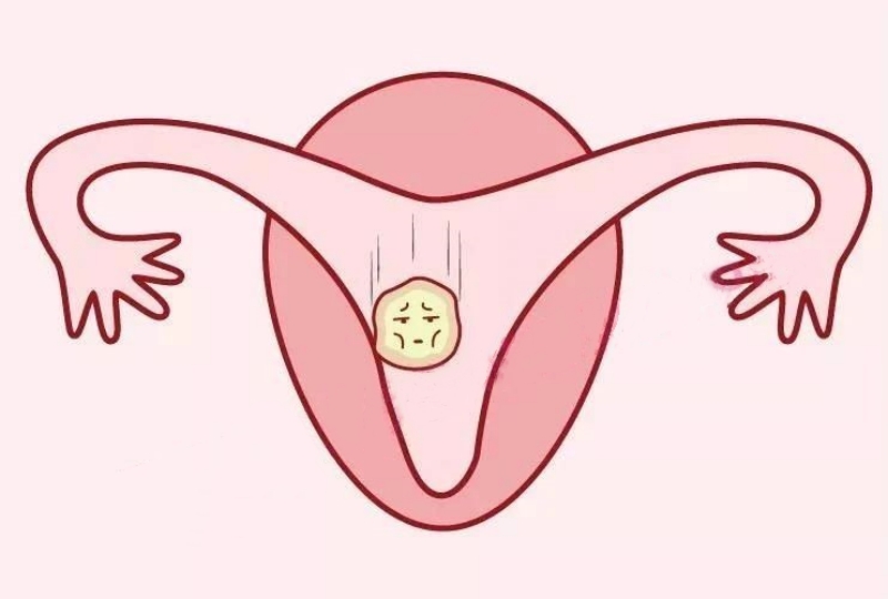 子宫内膜薄怎么办？什么样的内膜适合移植？